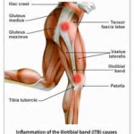 Introduction To The Iliotibial Band Syndrome 2